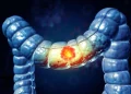 Un test simplu la domiciliu reduce cu 43% riscul de deces prin cancer colorectal