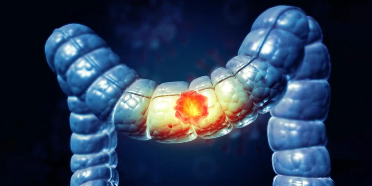 Un test simplu la domiciliu reduce cu 43% riscul de deces prin cancer colorectal